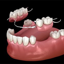 Illustration of partial denture for lower dental arch