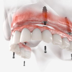 Illustration of implant denture for upper dental arch