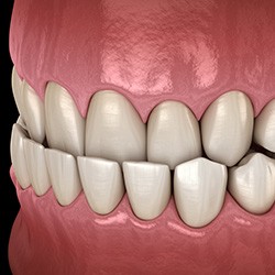 Illustration of underbite against dark background