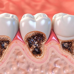 Illustration of decayed teeth