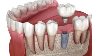 Illustration of a dental implant toward the back of a dental arch