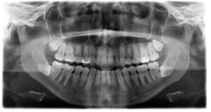 Dental X-ray showing sideways wisdom teeth