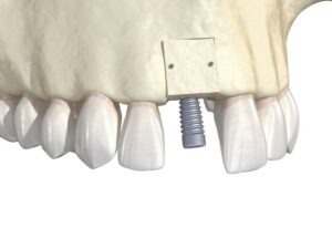 Illustration of dental implant at the location of a bone graft