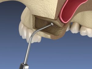 Illustration of sinus lift procedure